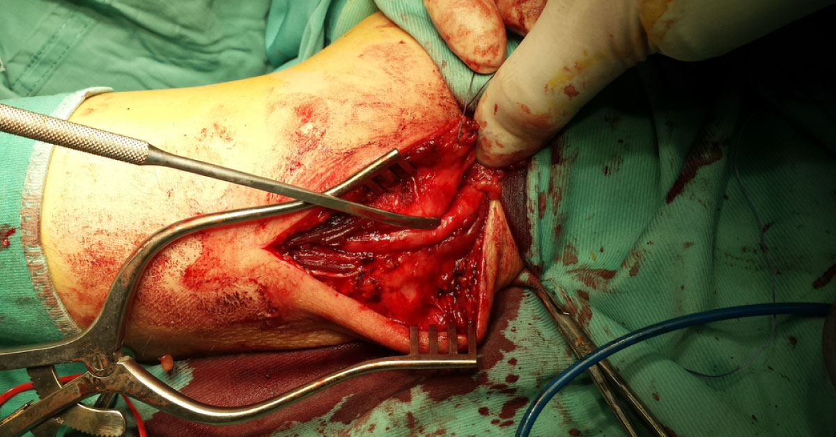 3 Advanced Techniques For Peripheral Nerve Repair